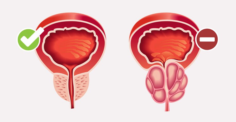 Weiprost normalizuje velikost a funkci prostaty