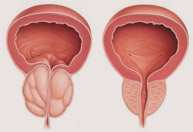 zdravá a zanícená prostata s prostatitidou